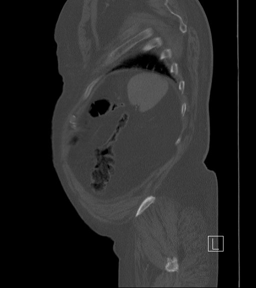 File:Bowel ischemia secondary to SMA occlusion with extensive portomesenteric venous gas (Radiopaedia 54656-60871 Sagittal bone window 13).jpg