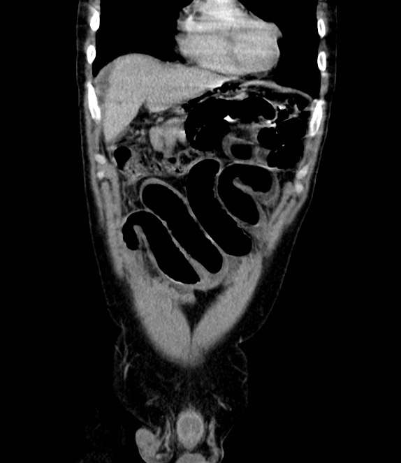 Bowel obstruction from colon carcinoma (Radiopaedia 22995-23028 C 14).jpg