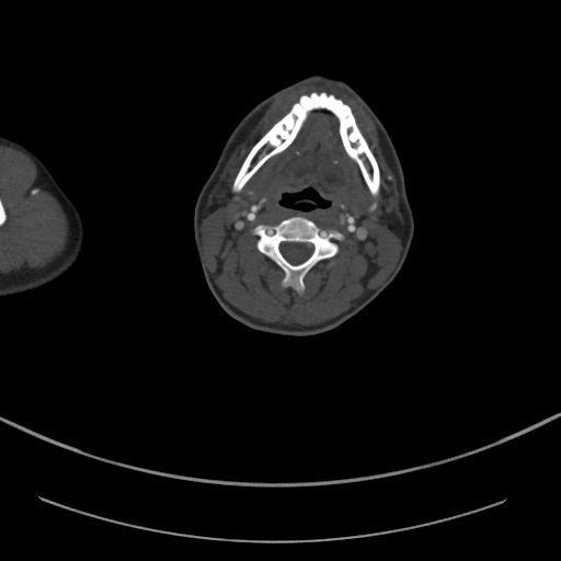 Brachiocephalic trunk pseudoaneurysm (Radiopaedia 70978-81191 Axial bone window 11).jpg