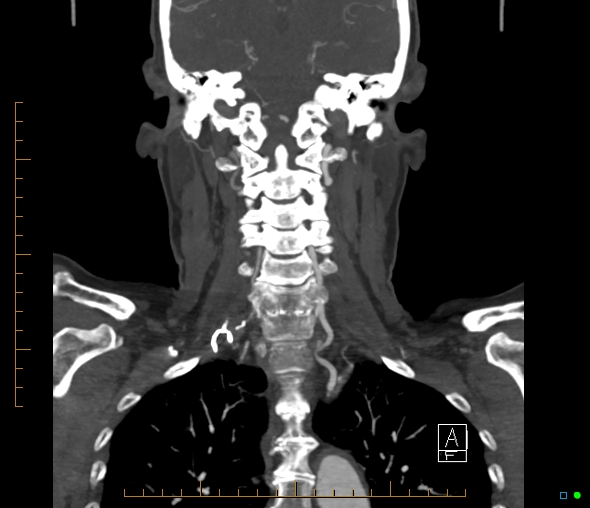 Brachiocephalic trunk stenosis (Radiopaedia 87242-103519 B 45).jpg