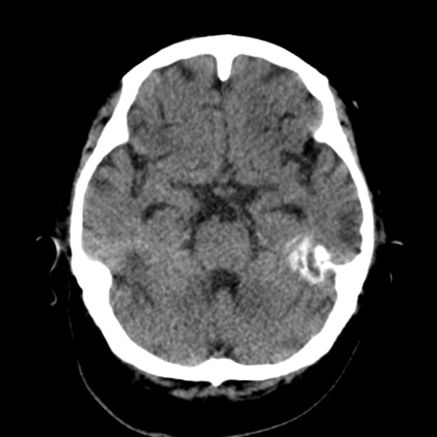 Brain cortical laminar necrosis (Radiopaedia 25822-25971 Axial non-contrast 14).jpg