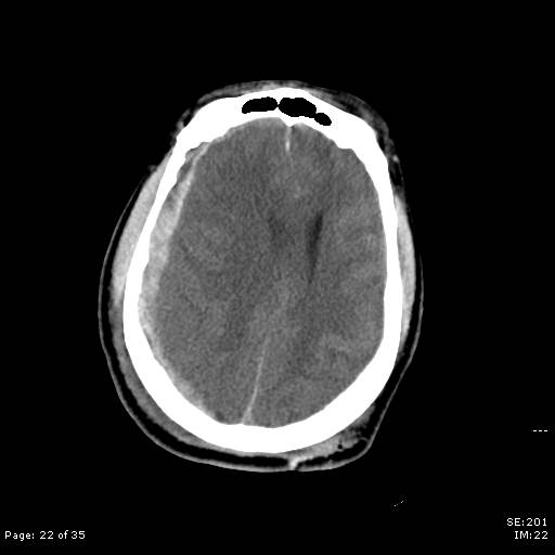 File:Brain death after motor vehicle collision (Radiopaedia 88470-105114 Axial non-contrast 22).jpg
