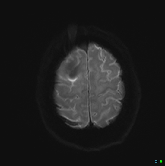 File:Brain death on MRI and CT angiography (Radiopaedia 42560-45689 Axial DWI 23).jpg