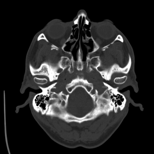 Brain metastases from lung cancer (Radiopaedia 24480-24781 Axial bone window 5).jpg