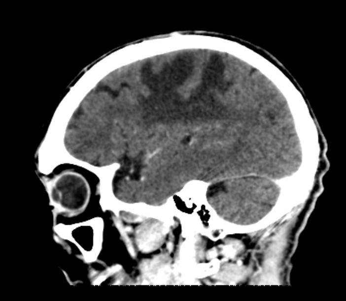 Brain metastases from lung cancer (Radiopaedia 27849-28092 Sagittal C+ delayed 17).jpg