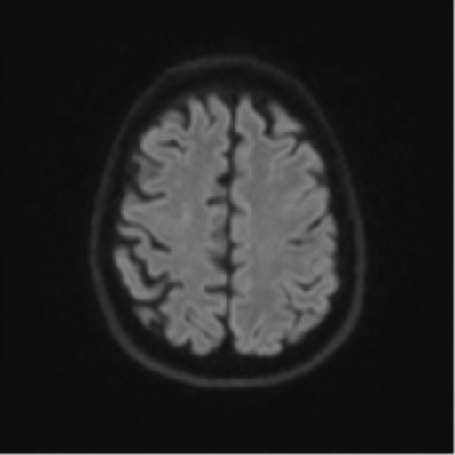 Brain metastasis (large cystic mass) (Radiopaedia 47497-52107 Axial DWI 49).png
