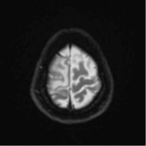 File:Brain metastasis (sarcoma) (Radiopaedia 47576-52209 Axial DWI 24).png
