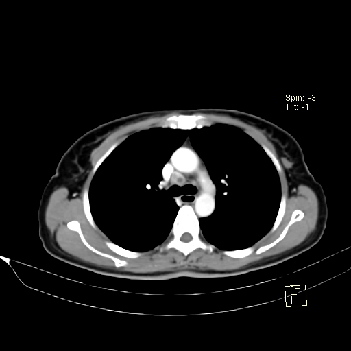 Brain metastasis as initial presentation of non-small cell lung cancer (Radiopaedia 65122-74127 A 18).jpg
