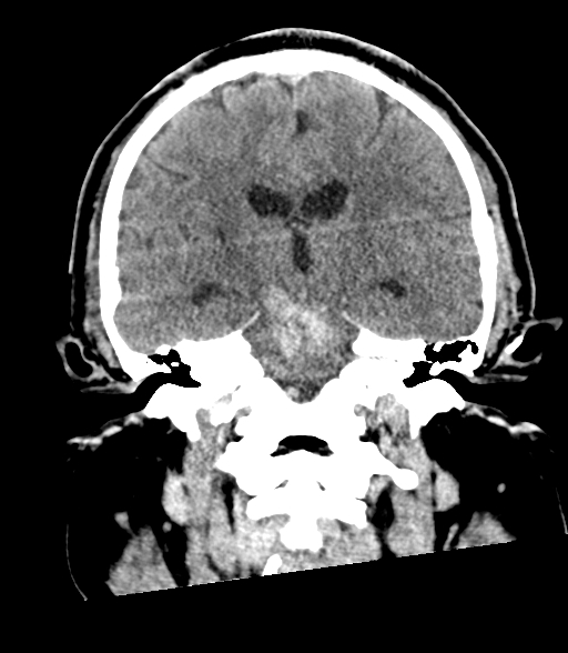 Brainstem hemorrhage (Radiopaedia 81294-94976 Coronal non-contrast 38).jpg