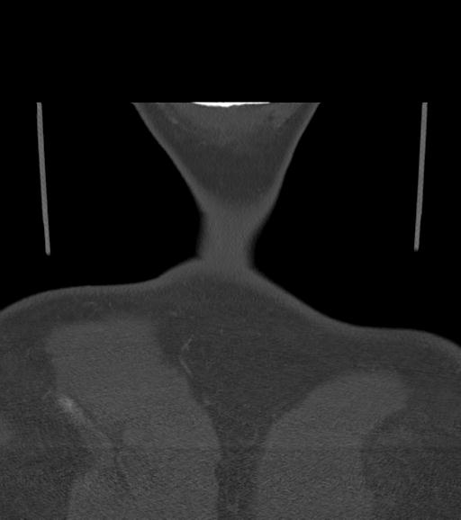 Branchial cleft cyst (Radiopaedia 31167-31875 Coronal bone window 65).jpg