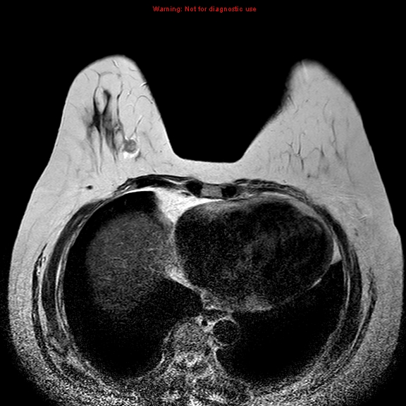 File:Breast carcinoma (multicentric multifocal in mammary Paget disease) (Radiopaedia 50966-56512 Axial T2 2).jpg