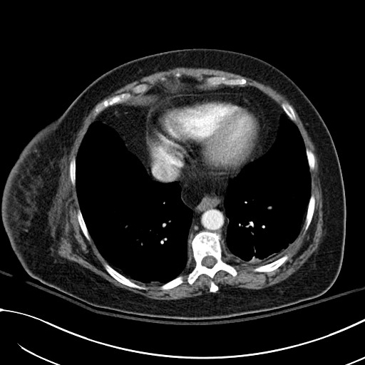 File:Breast carcinoma with pathological hip fracture (Radiopaedia 60314-67974 A 40).jpg