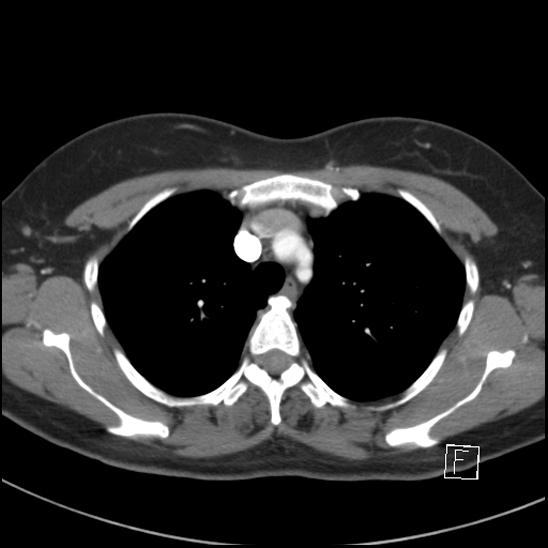 Breast metastases from renal cell cancer (Radiopaedia 79220-92225 A 25).jpg