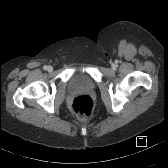 File:Breast metastases from renal cell cancer (Radiopaedia 79220-92225 C 120).jpg