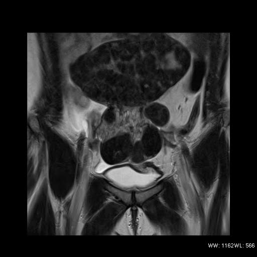 File:Broad ligament fibroid (Radiopaedia 49135-54241 Coronal T2 7).jpg
