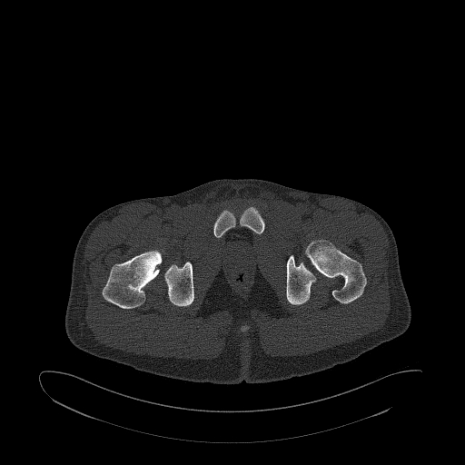 Brodie abscess- femoral neck (Radiopaedia 53862-59966 Axial bone window 177).jpg