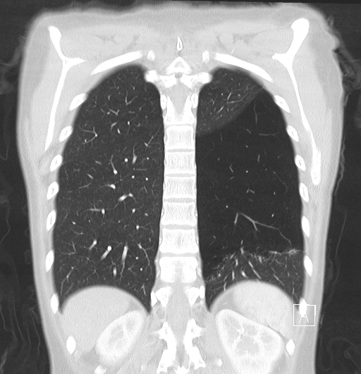 File:Bronchial atresia (Radiopaedia 73677-84470 Coronal lung window 27).jpg
