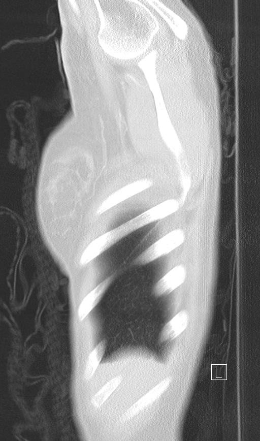 Bronchial atresia (Radiopaedia 73677-84470 Sagittal lung window 3).jpg