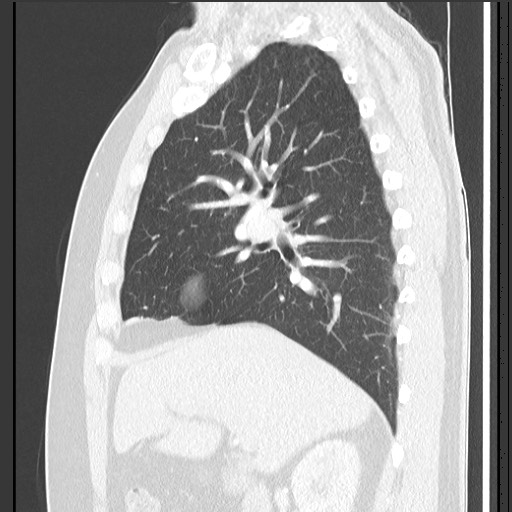 Bronchial carcinoid tumor (Radiopaedia 67377-76764 Sagittal lung window 26).jpg