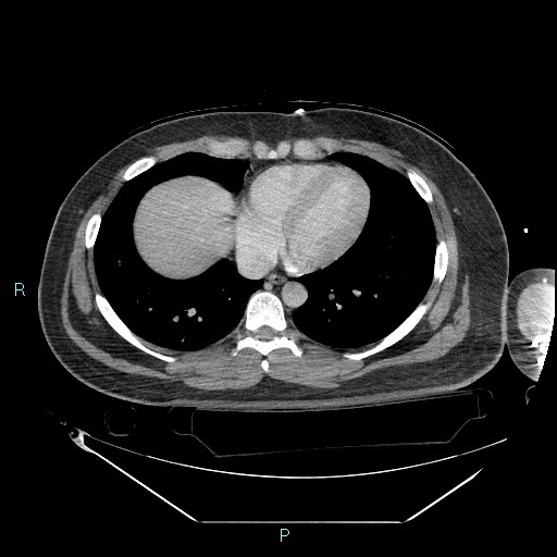 Bronchial carcinoid tumor (Radiopaedia 78272-90870 C 84).jpg