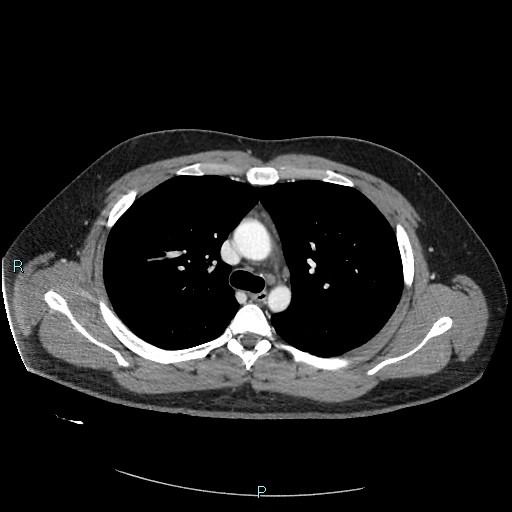 File:Bronchial carcinoid tumor (Radiopaedia 78272-90875 A 39).jpg