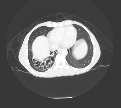 File:Bronchiectasis in Crohn disease (Radiopaedia 60311-67977 Axial lung window 16).jpg