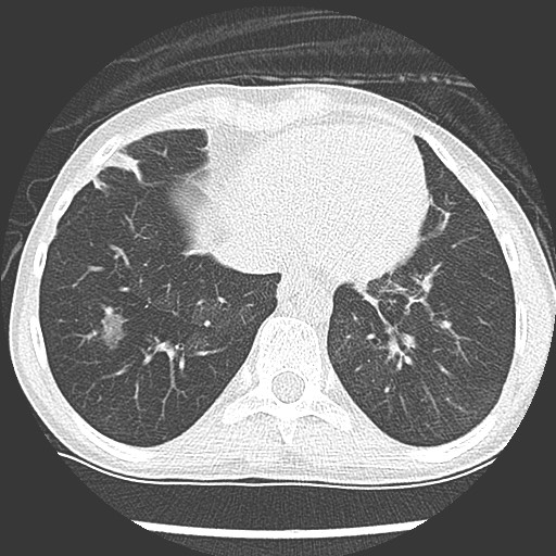 Bronchiolotis obliterans (Radiopaedia 73769-84575 Axial lung window 35).jpg