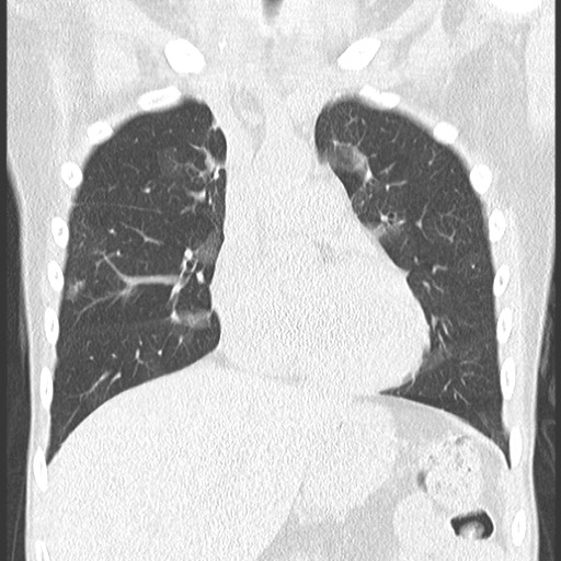 File:Bronchiolotis obliterans (Radiopaedia 73769-84575 Coronal lung window 16).jpg