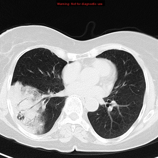 File:Bronchoalveolar carcinoma (BAC) (Radiopaedia 13436-13392 Axial lung window 30).jpg