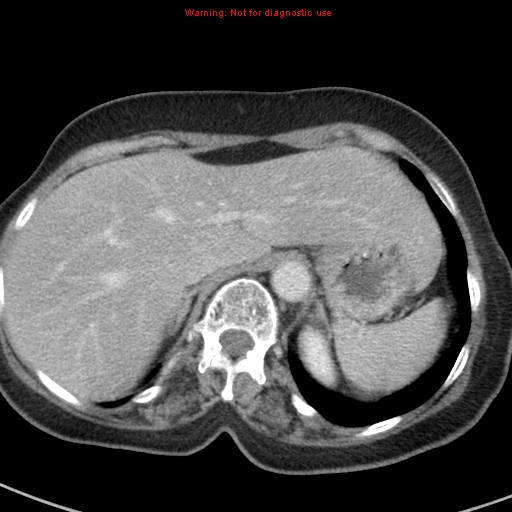 File:Bronchoalveolar carcinoma (BAC) (Radiopaedia 13436-13392 B 49).jpg