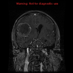 File:Bronchogenic carcinoma brain metastasis (Radiopaedia 9286-9969 Coronal T1 19).jpg