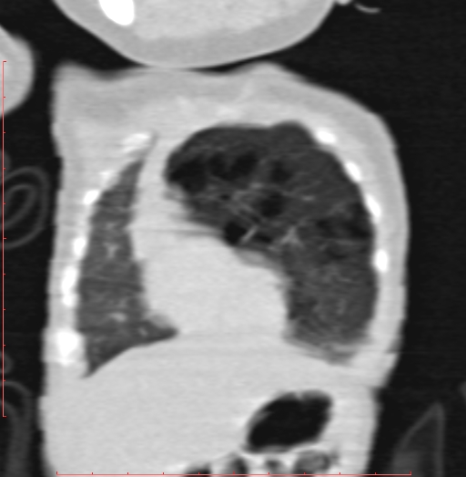 Bronchogenic cyst (Radiopaedia 78599-91409 Coronal lung window 48).jpg