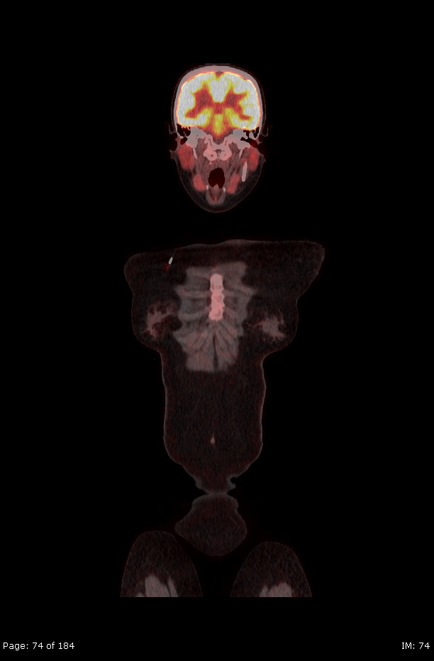 Brown fat uptake (FDG PET-CT) (Radiopaedia 77392-89513 Fused coronal 32).jpg