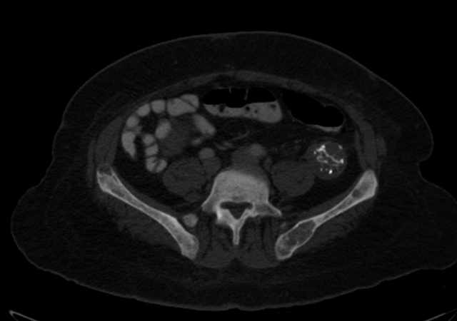 Brown tumors compressing the spinal cord (Radiopaedia 68442-77988 G 86).jpg
