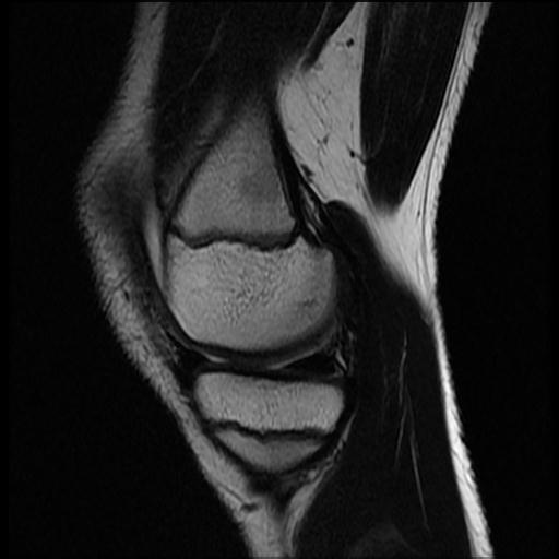 File:Bucket handle tear - lateral meniscus (Radiopaedia 72124-82634 Sagittal T2 12).jpg