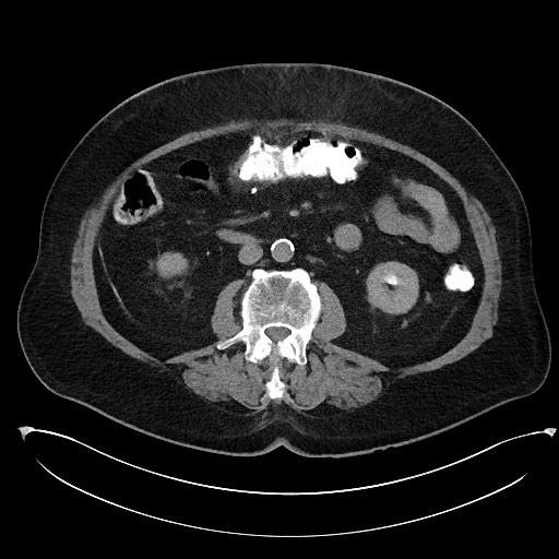 Buried bumper syndrome - gastrostomy tube (Radiopaedia 63843-72577 Axial Inject 55).jpg