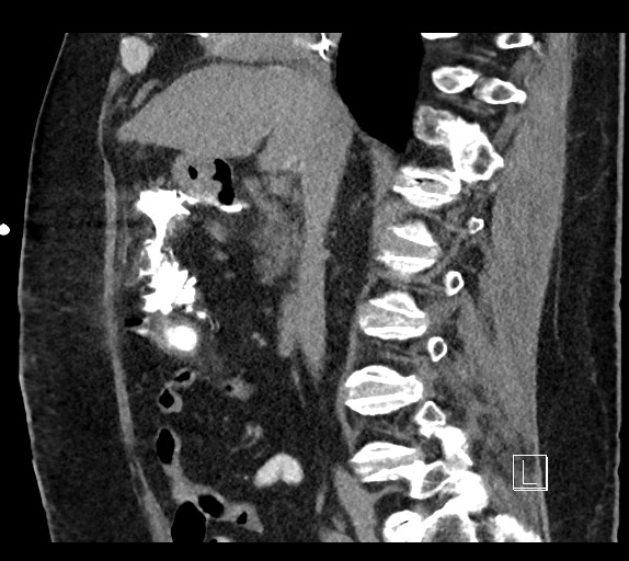 Buried bumper syndrome - gastrostomy tube (Radiopaedia 63843-72577 Sagittal Inject 70).jpg