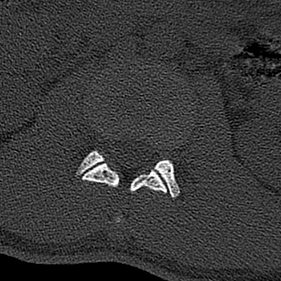 Burst fracture (Radiopaedia 53373-59357 Axial bone window 17).jpg