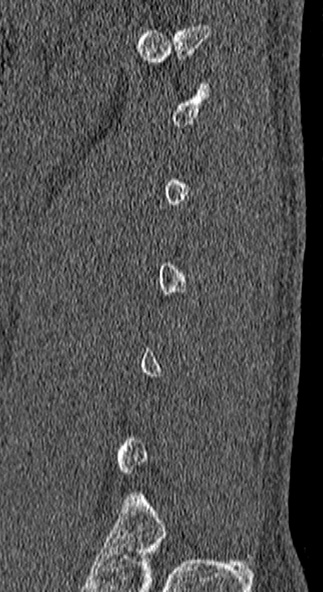 Burst fracture (Radiopaedia 53373-59357 Sagittal bone window 4).jpg