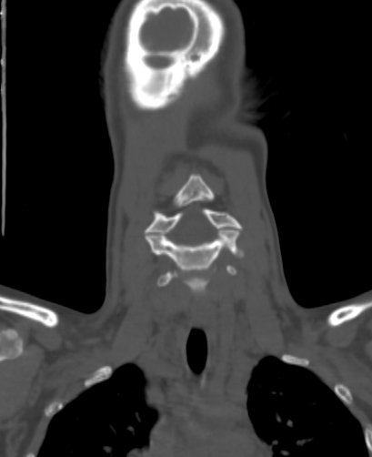 Butterfly vertebra (Radiopaedia 77903-90209 Coronal bone window 10).jpg