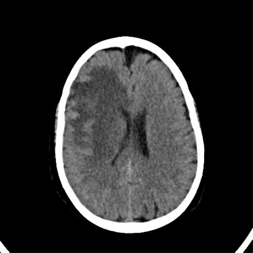 File:CNS Lymphoma (Radiopaedia 44198-47794 Axial non-contrast 24).png