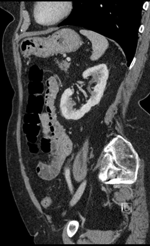 Calcified adrenal glands and Spigelian hernia (Radiopaedia 49741-54988 C 49).jpg