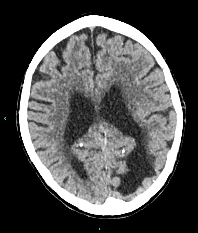 Calcified cerebral emboli from left ventricular thrombus (Radiopaedia 84420-99758 Axial non-contrast 38).jpg
