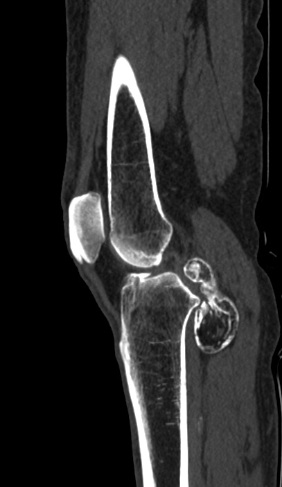 Calcified hematoma - popliteal fossa (Radiopaedia 63938-72763 Sagittal bone window 36).jpg