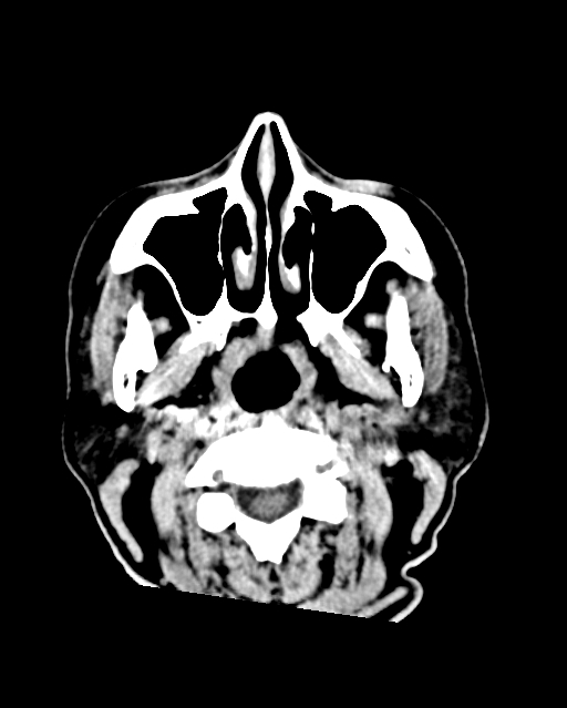 Calcified meningioma (Radiopaedia 74361-85243 Axial non-contrast 57).jpg
