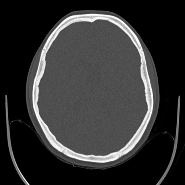 Calvarial osteoma (Radiopaedia 36520-38079 Axial bone window 63).jpg