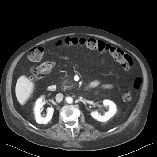 Cannonball metastases from endometrial cancer (Radiopaedia 42003-45031 E 32).png