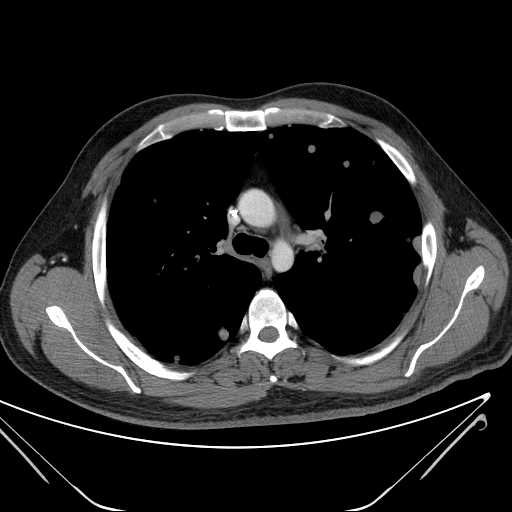 File:Cannonball pulmonary metastases (Radiopaedia 67684-77101 D 103).jpg