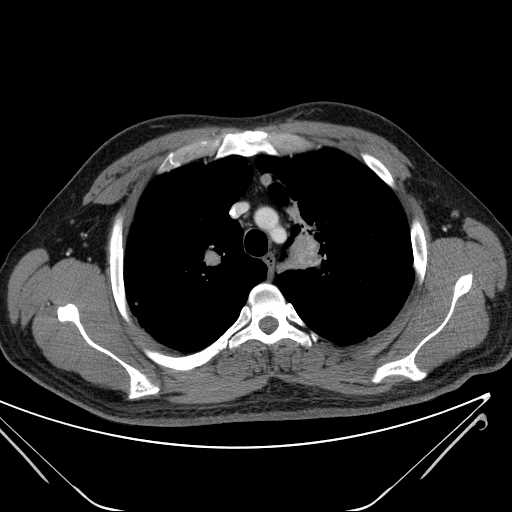 File:Cannonball pulmonary metastases (Radiopaedia 67684-77101 D 76).jpg