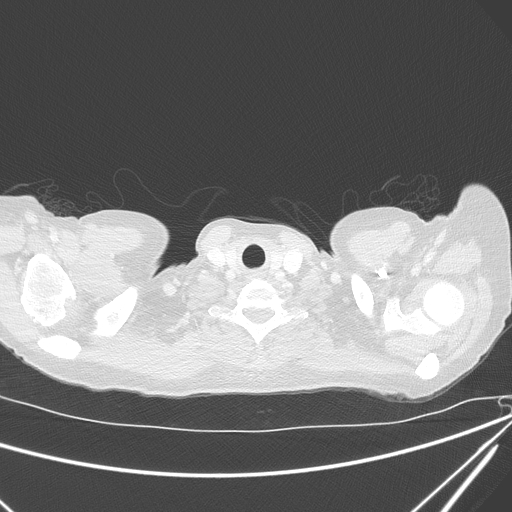 File:Canonball lung metastasis (Radiopaedia 77634-89837 Axial lung window 1).jpg